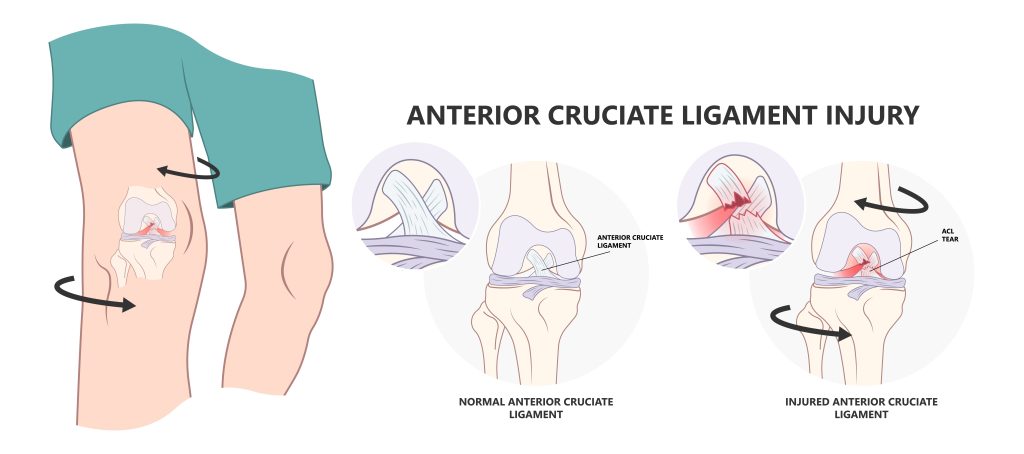 Anterior Cruciate Ligament Injury Manchester