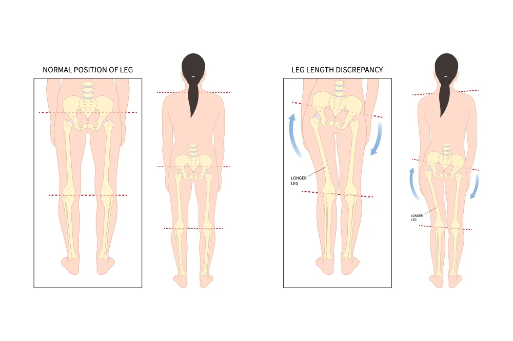 Limb Length Discrepancy in Children