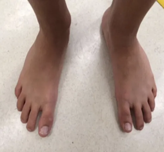 A fully corrected right-sided clubfoot of a 15 years old