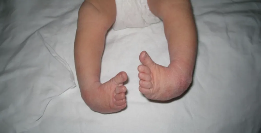 Congenital clubfoot