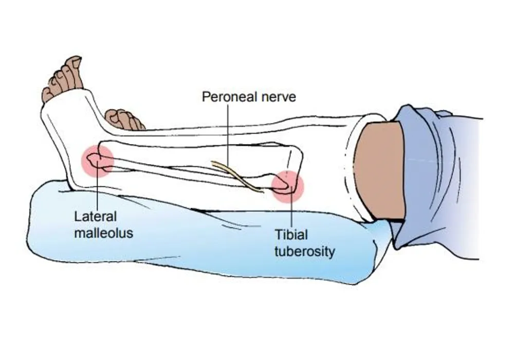 casted lower limbs